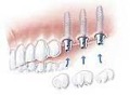 Replacing more teeth with dental implants