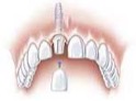 Replacing one tooth with a dental implant