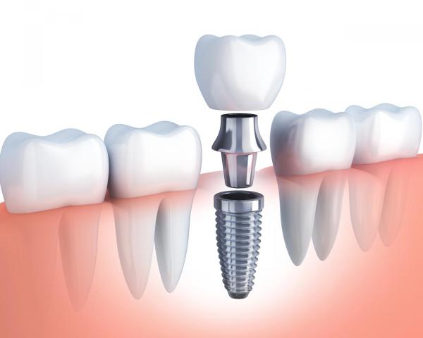 Dental implants or bridges?