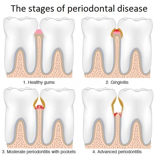 Gum (periodontal) disease and its effects
