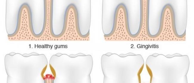 Gum (periodontal) disease and its effects